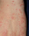 Acarodermatitis Hand.jpg