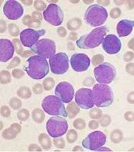 Acute leukemi.JPG