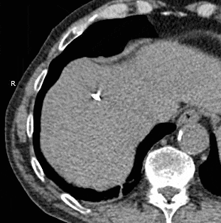Hepatic cryoablation.gif