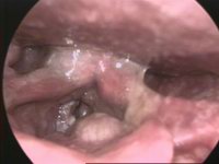 Tumor Laryngis-01.jpg
