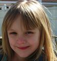 Again the same girl, age 5 years old. Note how the scar gets less visible with age.