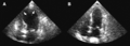 (A) Echocardiogram showing dilatation of the left ventricle in the acute phase (B) Resolution of left ventricular function on repeat echocardiogram six days later