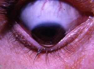 Keratoconus-with-Munsons-sign-USA-1965.jpg