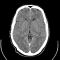 Computed tomography of brain of Mikael Häggström (14).png