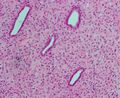 Micrograph of decidualized endometrium due to exogenous progesterone. H&E stain.