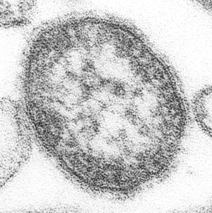 Transmission electron micrograph of measles virus