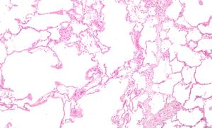 Emphysema low mag.jpg