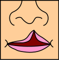 Unilateral incomplete