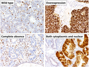 Patterns of p53 expression.png