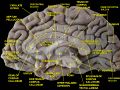 Medial surface of cerebral hemisphere.Medial view.Deep dissection.