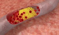 Cholesterol-plaque-in-an-artery.jpg