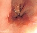 Endoscopic image of Barrett's esophagus, which is the area of red mucosa projecting like a tongue.