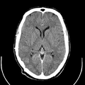 Computed tomography of brain of Mikael Häggström (15).png