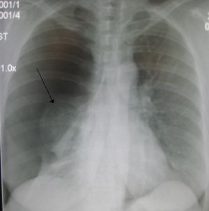 Rt sided pneumoD.jpg