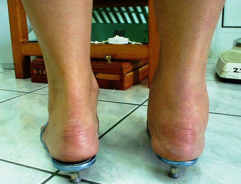 ملف:Ankle Joint Arthritis.jpg