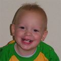Again the same boy, 18 months old. Note how the scar gets less visible with age.
