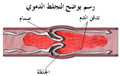 مخطط جلطة الدم.