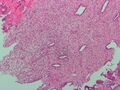 Micrograph of decidualized endometrium due to exogenous progesterone. H&E stain.