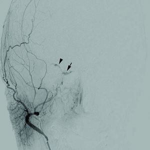 1471-2415-12-28-1Cerebral angiogram.jpg