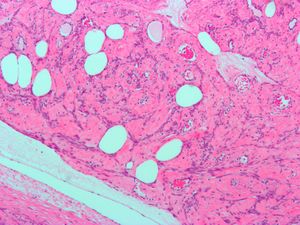 Lipoleiomyoma2.jpg