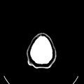 Computed tomography of brain of Mikael Häggström (32).png