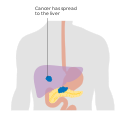 Metastasis – stage M1