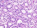Parathyroid adenoma histopathology (2).jpg