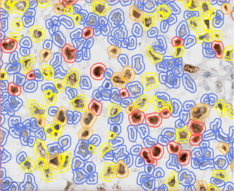 Ki67 stain calculation by QuPath in a pure seminoma, which gives a measure of the proliferation rate of the tumor. The colors represent the intensity of expression: blue-no expression, yellow-low, orange-moderate, and red-high expression.[8]