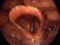 الحنجرة. 1=الأحبال الصوتية، 2=vestibular fold, 3=لسان المزمار، 4=plica aryepiglottica, 5=arytenoid cartilage, 6=sinus piriformis, 7=ظهر اللسان