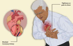 A man having a Heart Attack.png